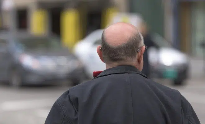 Aux alentours de 2000 euros pour une greffe de cheveux en Turquie